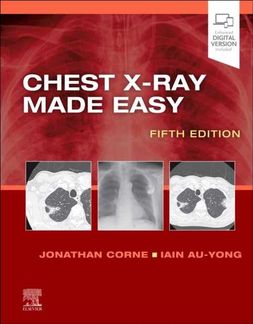 Bilde av Chest X-ray Made Easy Av Jonathan Ma Phd Mb Bs Frcp (consultant Respiratory Physician Nottingham University Hospitals Nhs Trust Nottingham Corne, Hea