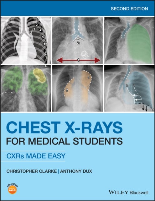 Bilde av Chest X-rays For Medical Students Av Christopher (st2 Clinical Radiology Trainee At Nottingham University Hospitals And Honorary Lecturer In Human Ana